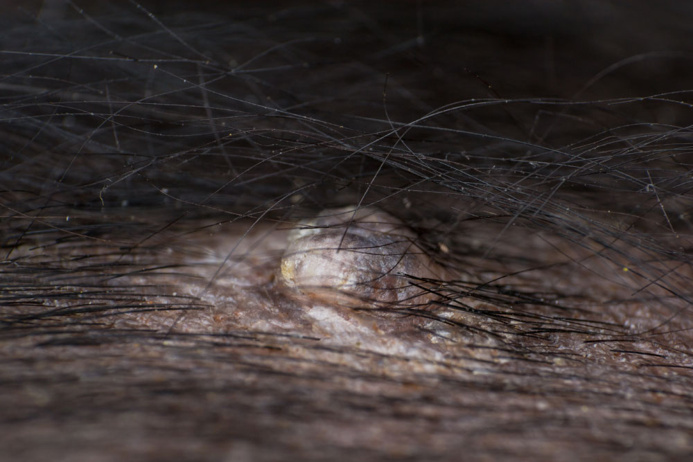Close-up of a mole on human skin, surrounded by dark hair. The mole is slightly raised with a textured surface, sitting atop a patch of rough skin. The image focuses on the mole and its immediate surroundings.